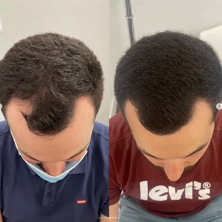 Zlepšenie hustoty vlasov ošetrením ASCE+ HRLV