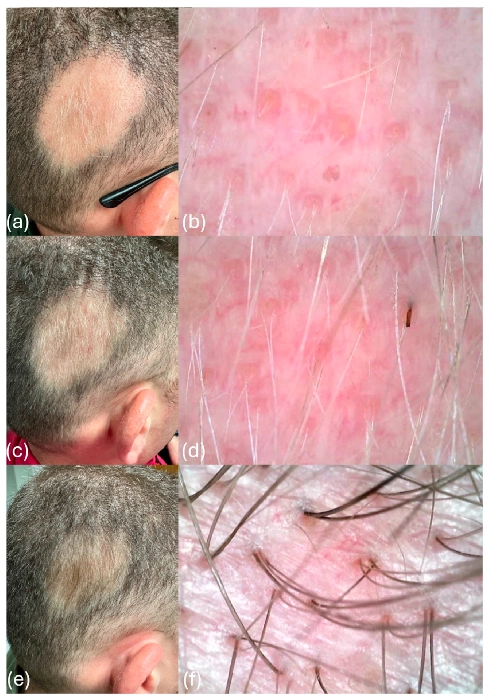 Klinická štúdia rastu vlasov po aplikácii exozómov 2024