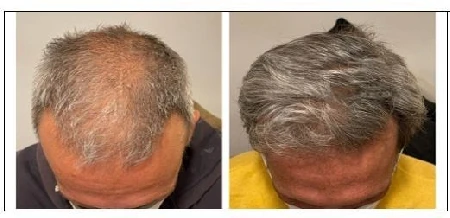 Viditeľné zahustenie rednúcich vlasov Prešov