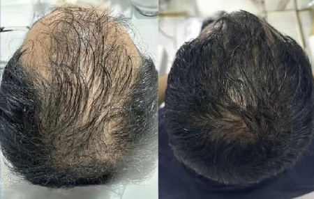 Moderná mezoterapia vlasov s exozómami výsledky