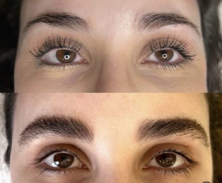 Regenerácia a zahustenie obočia exozómami Prešov pred a po