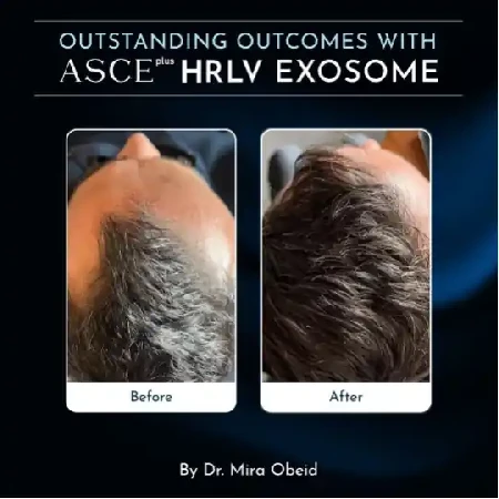 Liečba alopécie u mužov exozómy pred a po