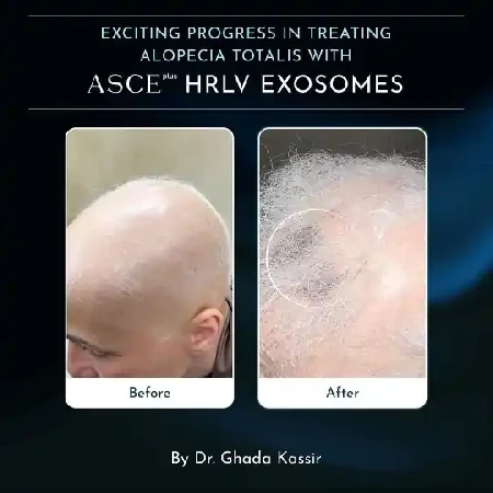 Obnova rastu vlasov na temene hlavy Prešov