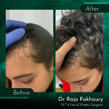 Riešenie vypadávania vlasov u žien ASCE+ HRLV