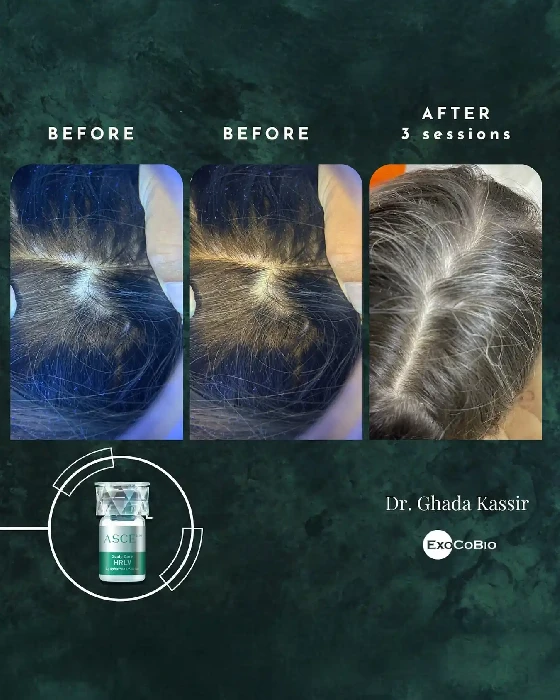 Nárast objemu vlasov po ošetrení exozómami