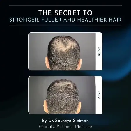 Regenerácia vlasových folikulov exozómy Prešov