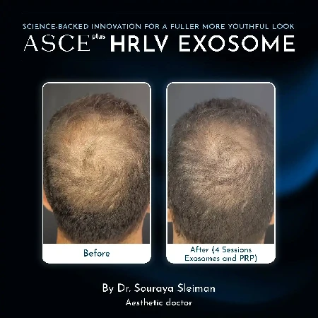 Celková transformácia vlasov po kúre ASCE+ HRLV