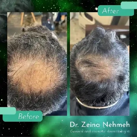 Profesionálne ošetrenie rednutia vlasov Prešov