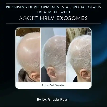 Zdravá pokožka hlavy a nové vlasy exozómy