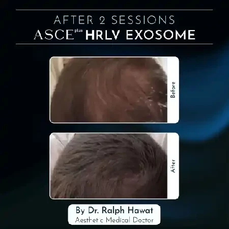 Zahustenie kúta vlasov exozómy Prešov