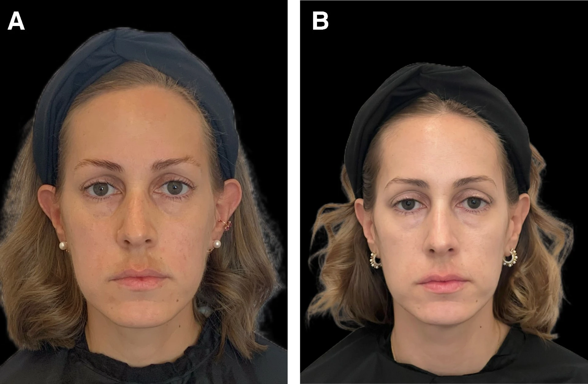 Post-zápalová hyperpigmentácia