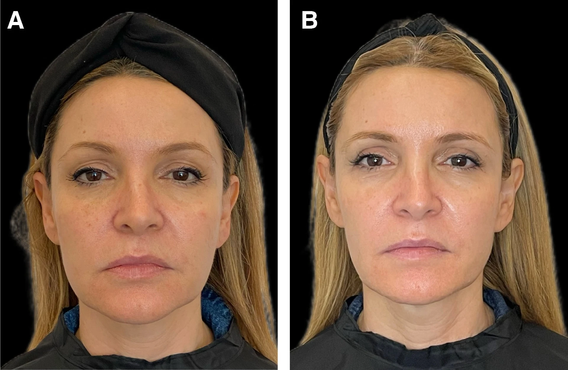 Fotopoškodená pokožka