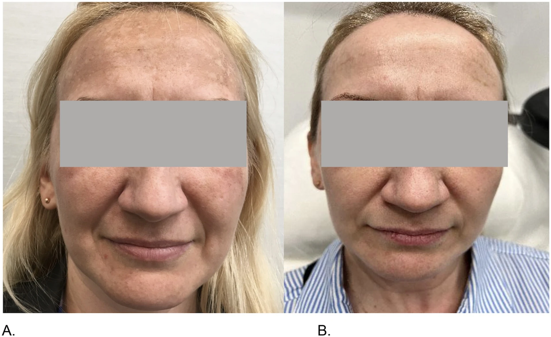 Redukcia hyperpigmentácie tváre