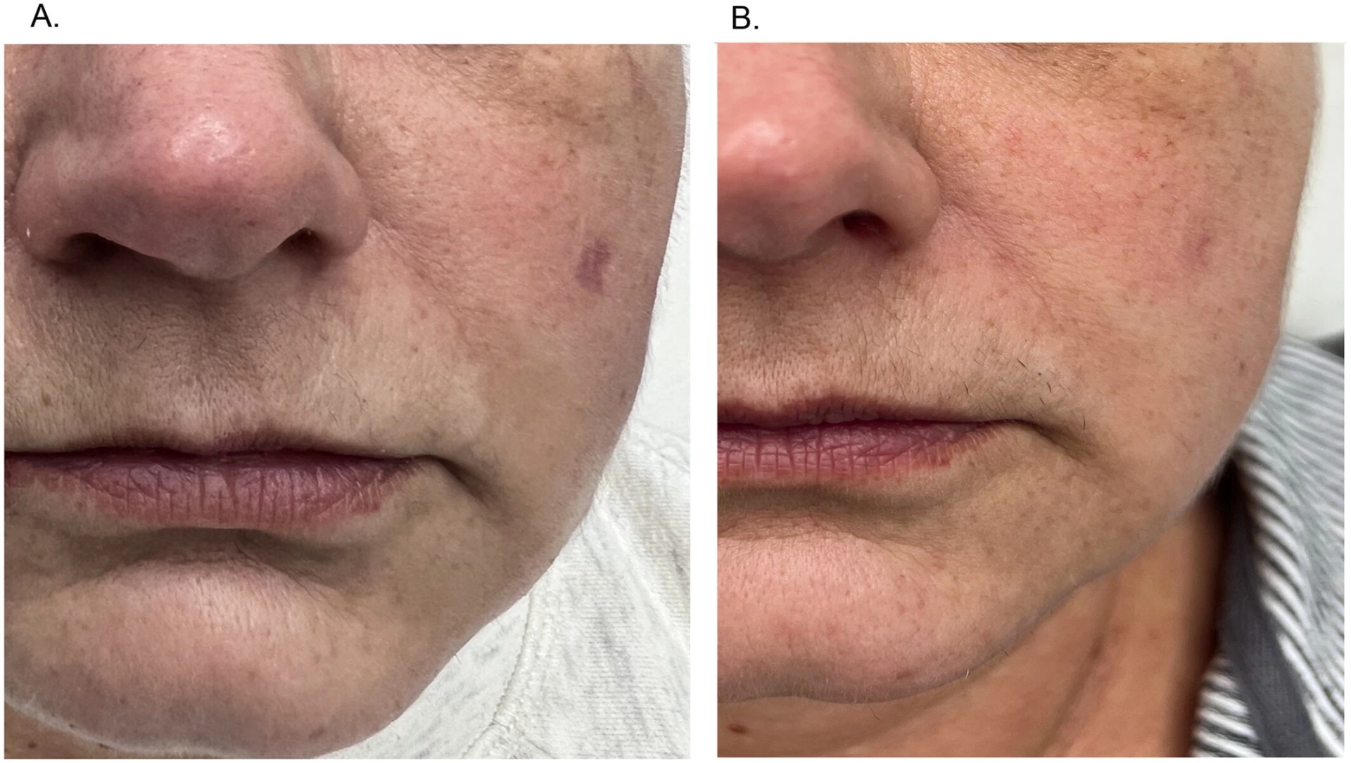 Zlepšenie pigmentových škvŕn